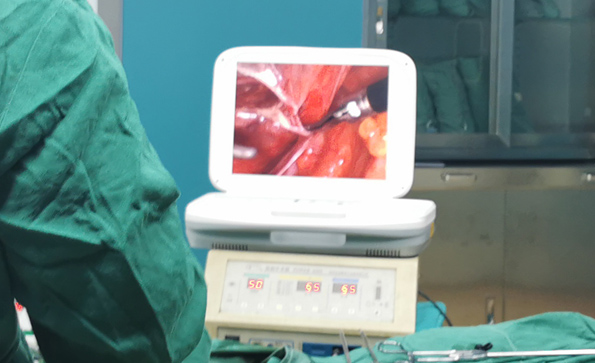 宮腔鏡和腹腔鏡有什么不同？