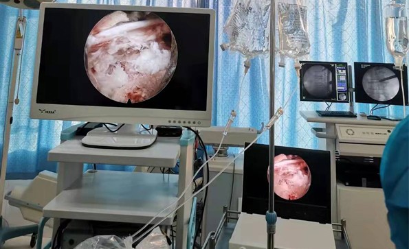 椎間孔鏡的基本配置有哪些？有哪些優(yōu)勢(shì)？